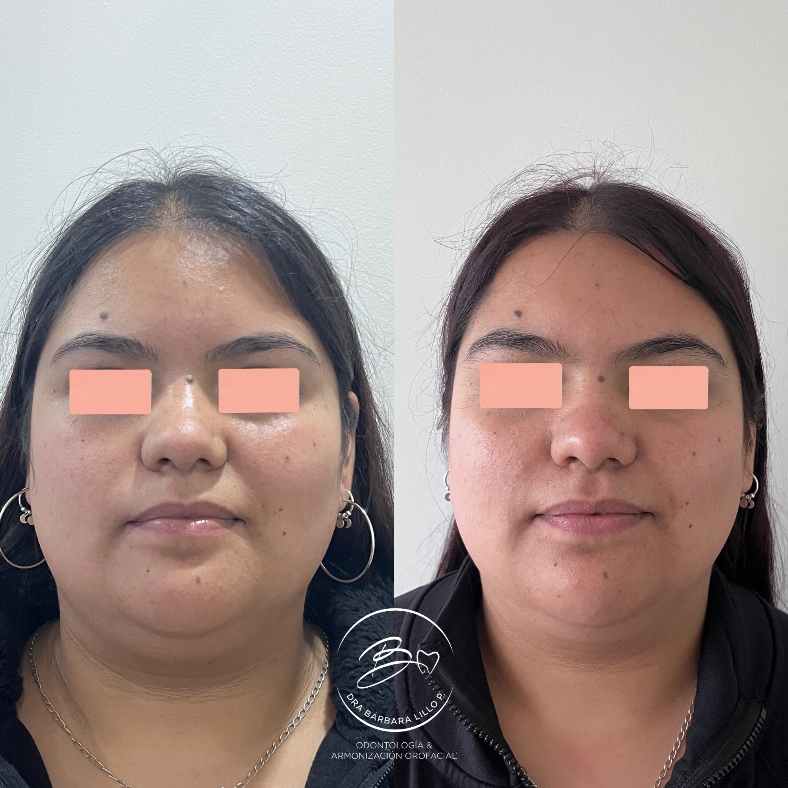 LIPOPAPADA 2