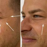 Líneas de expresión (Botox)