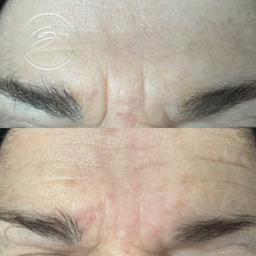 Viscoderm